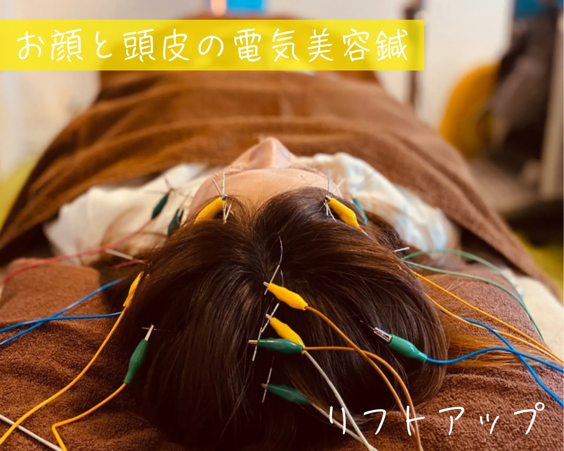 お顔の電気を流す美容鍼